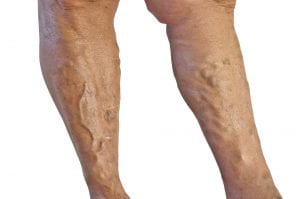 Bulging, ropy veins are a symptom of varicose vein disease.